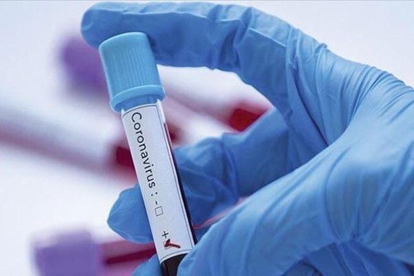Azərbaycanda daha 67 nəfərdə koronavirusa yoluxdu, 1 nəfər öldü