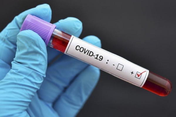 Türkiyədə bu gün koronavirusdan 20 nəfər ölüb 